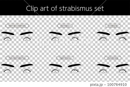 Medical illustration, eye disease, strabismus Illustrated line drawing illustration of exotropia 100764910