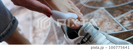 Hallux valgus on legs of woman with retainer puts on sneakers closeup Hallux valgus on legs of woman with retainer puts on sneakers closeup 100775641