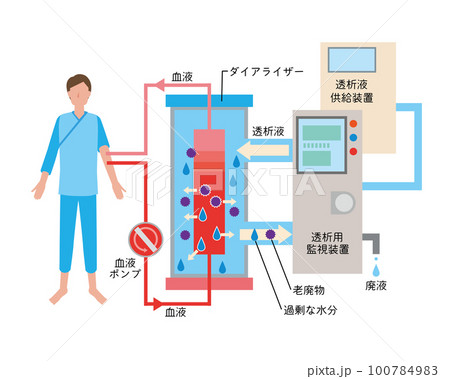 人工透析治療のイメージイラスト 人工透析治療のイメージイラスト 100784983