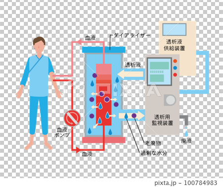 人工透析治療のイメージイラスト 人工透析治療のイメージイラスト 100784983