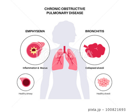 Chronic obstructive pulmonary diseaseのイラスト素材 [100821693] - PIXTA