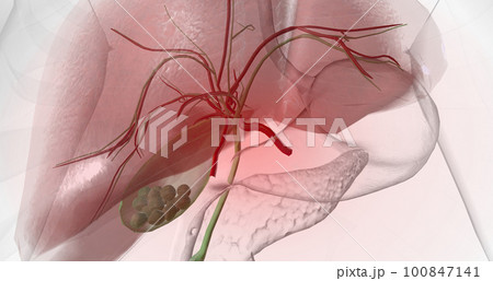 Gallstones are pieces of solid material that form in the gallbladder, a small hollow organ located beneath the liver. 100847141