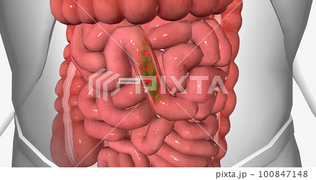 Diarrhea is the passage of loose, watery stool. 100847148