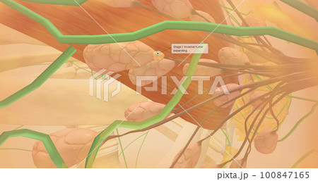 Stage I breast tumors are invasive and have started to spread to the fatty breast tissue or to nearby lymph nodes. 100847165