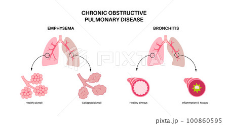 Chronic obstructive pulmonary disease 100860595