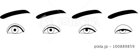 医療イラスト、眼瞼下垂の症状 正常~重症 医療イラスト、眼瞼下垂の症状 正常~重症 100889859