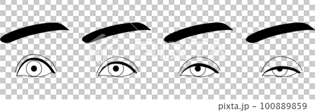 医療イラスト、眼瞼下垂の症状 正常~重症 医療イラスト、眼瞼下垂の症状 正常~重症 100889859