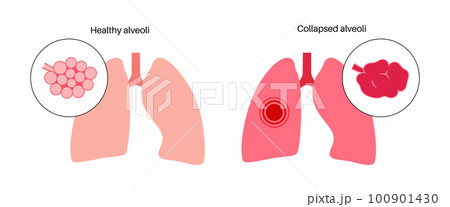 Emphysema anatomical poster Emphysema anatomical poster 100901430