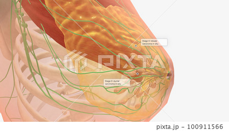 Stage 0 breast tumors are in situ; they remain in the area in which they originated and show no signs of spreading to nearby tissues. 100911566