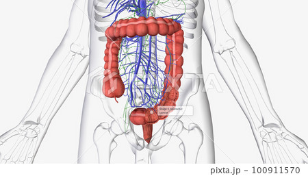 Colorectal cancer (CRC) is a common colon or rectal cancer that affects many patients over middle age. Colorectal cancer (CRC) is a common colon or rectal cancer that affects many patients over middle age. 100911570
