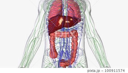 Colorectal cancer (CRC) is a common colon or rectal cancer that affects many patients over middle age. Colorectal cancer (CRC) is a common colon or rectal cancer that affects many patients over middle age. 100911574