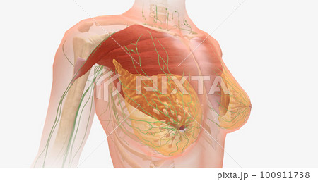 Stage II breast tumors are invasive. The tumor may have grown in size and spread to additional lymph nodes. 100911738