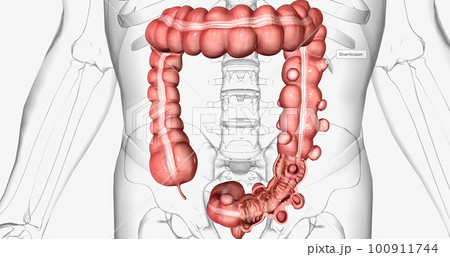 Diverticulosis is a condition characterized by the formation of diverticula in the walls of the intestines. 100911744
