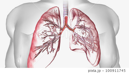 Cystic fibrosis is a genetically inherited disease that affects secretory cells throughout the body. 100911745