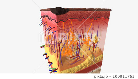 In Stage I ALM, the tumor is very small and located on the top-most layer of the skin, the epidermis. 100911763