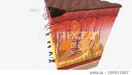 In Stage I ALM, the tumor is very small and located on the top-most layer of the skin, the epidermis. In Stage I ALM, the tumor is very small and located on the top-most layer of the skin, the epidermis. 100911807