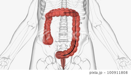 Colonoscopy is an invasive procedure used to look inside the large intestines. 100911808