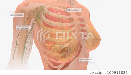 Stage IV breast tumors are invasive and have spread beyond the localized area to the lungs, bones, liver, brain, or to distant lymph nodes. Stage IV breast tumors are invasive and have spread beyond the localized area to the lungs, bones, liver, brain, or to distant lymph nodes. 100911825