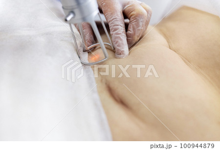 Extreme close up of hand of doctor or cosmetologist in transparent glove, part of apparatus, red laser beam and lower abdomen of female patient or client. Extreme close up of hand of doctor or cosmetologist in transparent glove, part of apparatus, red laser beam and lower abdomen of female patient or client. 100944879