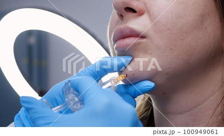 A doctor inserts painkillers into the chin area of womans face 100949061