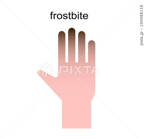 Frozen hand with fingers vector illustration. Medical frostbite. Frozen hand with fingers vector illustration. Medical frostbite. 100988116
