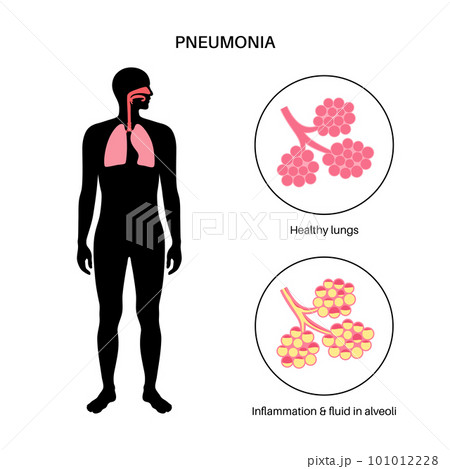 Pneumonia infection poster 101012228