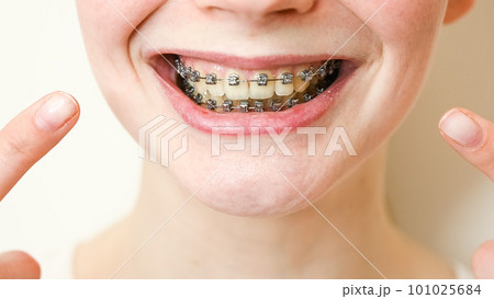 Close-up portrait of a young woman pointing at a smile with braces on her teeth. Close-up portrait of a young woman pointing at a smile with braces on her teeth. 101025684