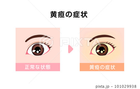黄疸(おうだん) の眼球と健康な眼球の比較イラスト 黄疸(おうだん) の眼球と健康な眼球の比較イラスト 101029938