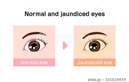 黄疸(おうだん) の眼球と健康な眼球の比較イラスト(英語) 黄疸(おうだん) の眼球と健康な眼球の比較イラスト(英語) 101029939