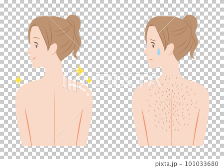 背中の脱毛ビフォーアフター 101033680