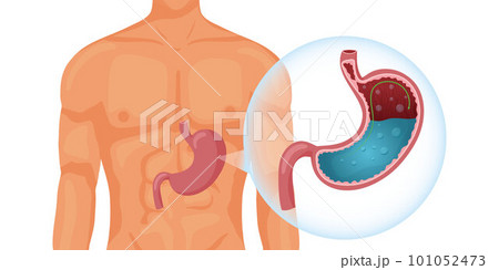 Full human stomach in body 101052473