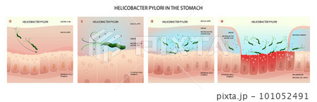 Helicobacter pylori in human stomach, inflammation development stages Helicobacter pylori in human stomach, inflammation development stages 101052491