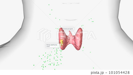 Hyperparathyroidism is a condition in which high amounts of parathyroid hormone are produced by the parathyroid gland. 101054428