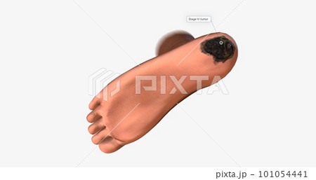 Acral Lentiginous Melanoma (ALM) on The Body 101054441