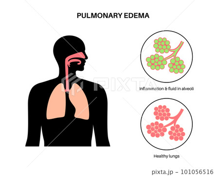 Pulmonary edema disease Pulmonary edema disease 101056516