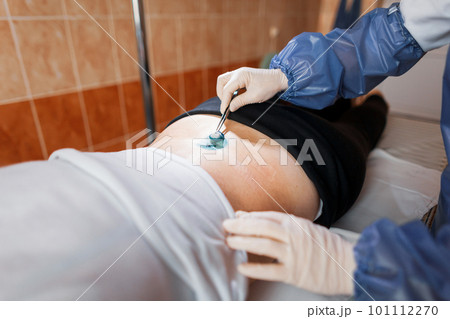 Medical assistant in a medical uniform lubricates the wound with an antibacterial solution to heal wounds after surgery. Providing medical care to the patient 101112270