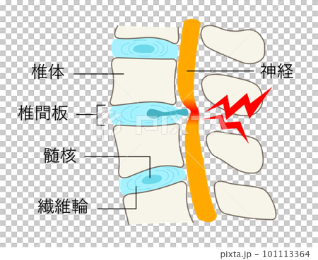 椎間板ヘルニアになった腰椎のイラスト 101113364