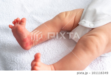 Hemangioma red birthmark on the leg of newborn baby Hemangioma red birthmark on the leg of newborn baby 101116349