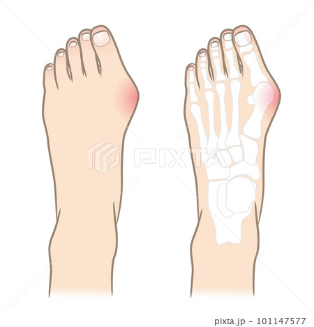 外反母趾の足のイラスト 101147577