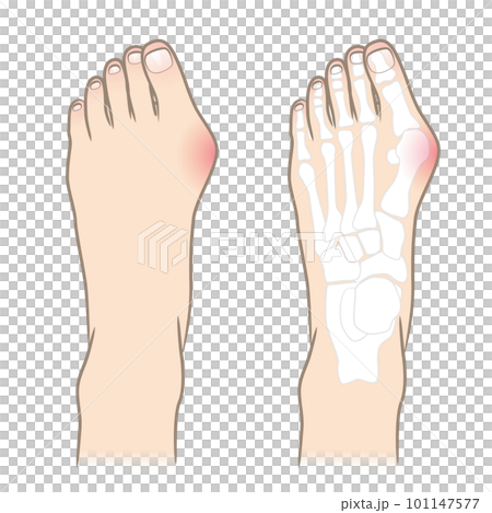 拇趾外翻腳圖 101147577