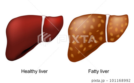 fatty liver disease. Healthy liver and hepatic steatosis. fatty liver disease. Healthy liver and hepatic steatosis. 101168992