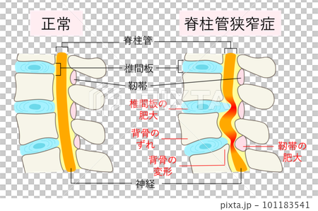 正常な腰椎と脊柱管狭窄症の比較イラスト 101183541
