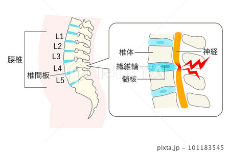 ぎっくり腰になった腰椎の説明イラスト拡大図 101183545