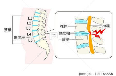 椎間板ヘルニアになった腰椎の説明イラスト拡大図 椎間板ヘルニアになった腰椎の説明イラスト拡大図 101183550