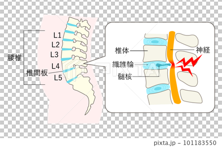 椎間板ヘルニアになった腰椎の説明イラスト拡大図 椎間板ヘルニアになった腰椎の説明イラスト拡大図 101183550