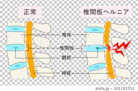 Comparison illustration of normal lumbar vertebrae and intervertebral disc herniation 101183552