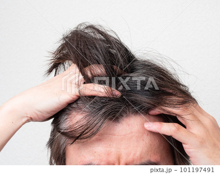 白髪と薄毛を気にする男性の頭 101197491