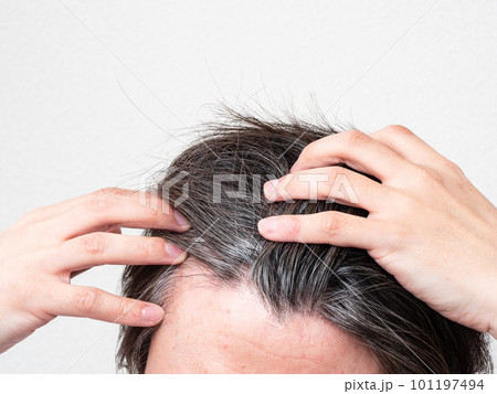 白髪と薄毛を気にする男性の頭 101197494