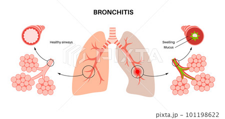 Bronchitis lung disease 101198622