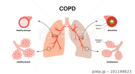 Chronic obstructive pulmonary disease Chronic obstructive pulmonary disease 101198623